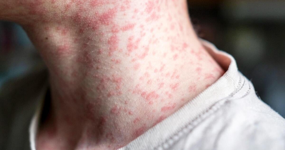 Measles Case Confirmed in Oakland County, Michigan: What You Need to Know