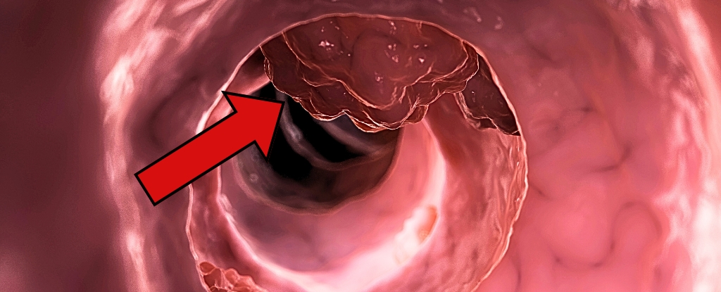 Aspirin: A Potential Game-Changer in Preventing Colorectal Cancer Recurrence