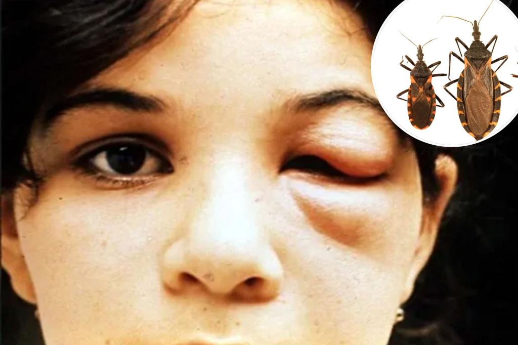 Kissing Bug Disease: What You Need to Know About Symptoms and Treatment